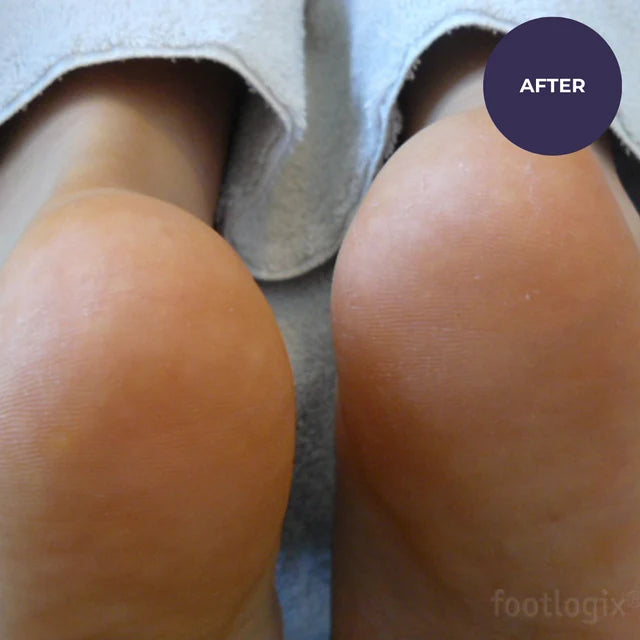 Footlogix Very Dry Skin Formula (125ml)